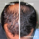HairMax Ultima 12 Classic Laser Hair Growth Device – LaserComb